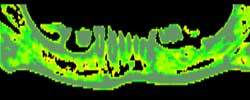 Bone Quality Panoramic Bone Quality Panoramic